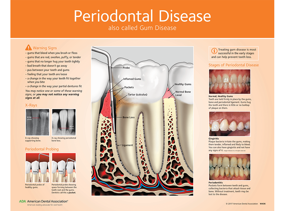 Periodontal Disease Chart A Visual Reference of Charts Chart Master