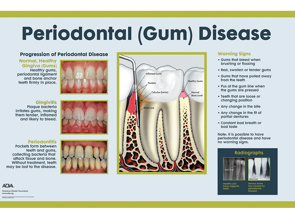 Periodontal Gum Chart