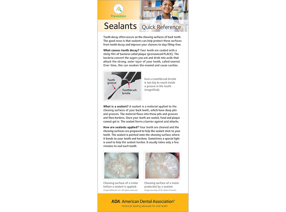 Sealants Quick Reference Card Prevent Tooth Decay ADA Catalog