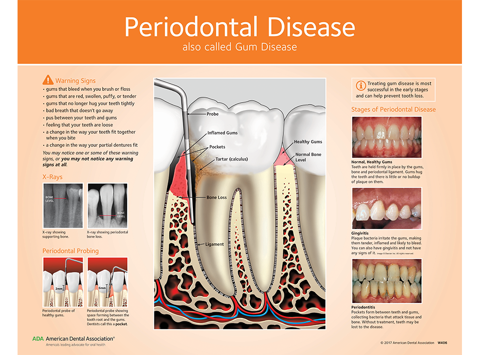 Periodontal (Gum) Disease Chart