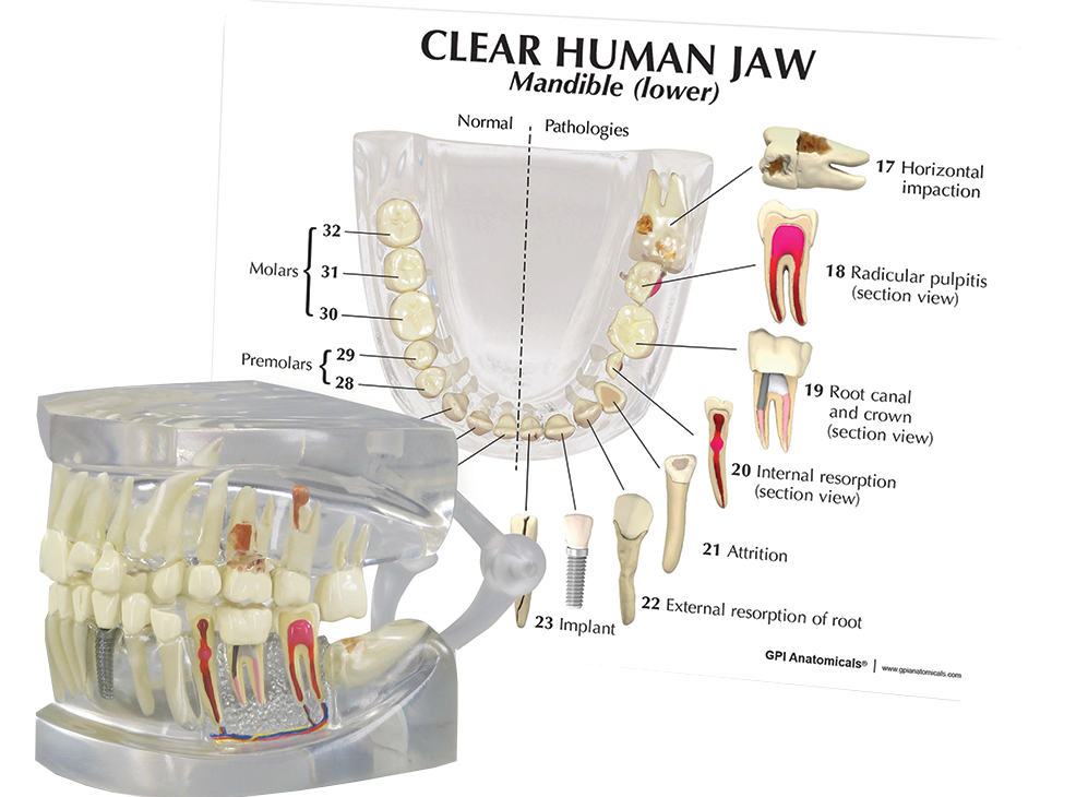 Clear Jaw with Pathologies Model