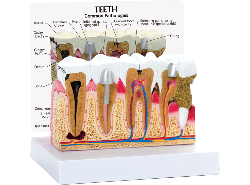 Diseased Tooth Model Image 0