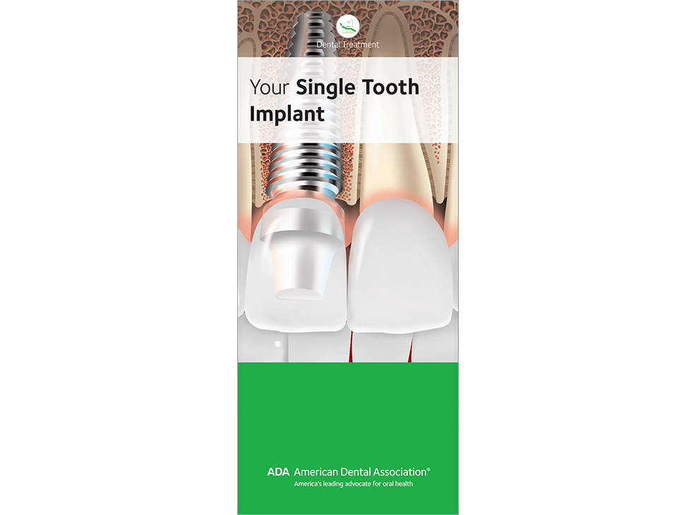 Your Single Tooth Implant