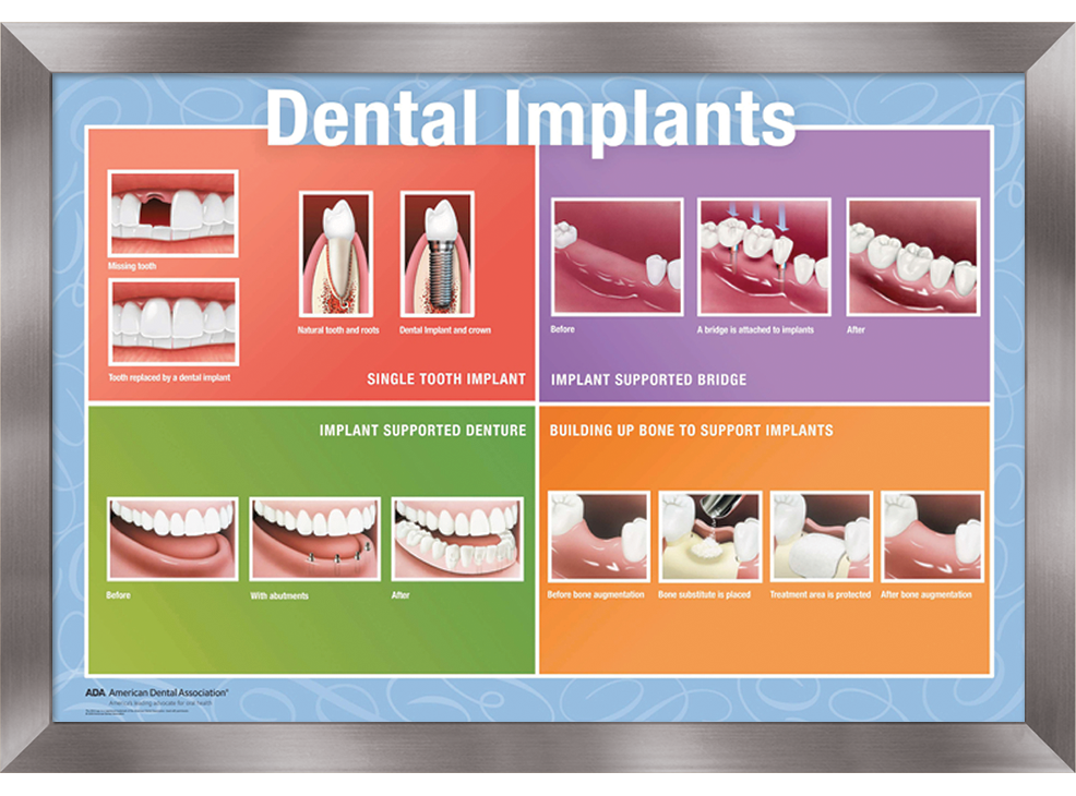 16" x 20" Framed Wall Art, Dental Implants Image 0