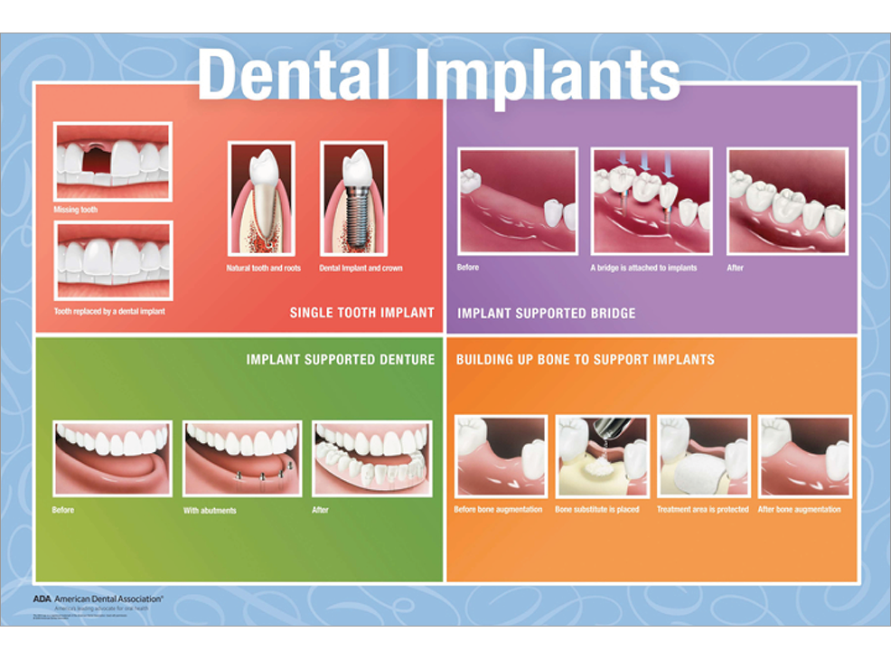16" x 20" Unframed Wall Art, Dental Implants Image 0