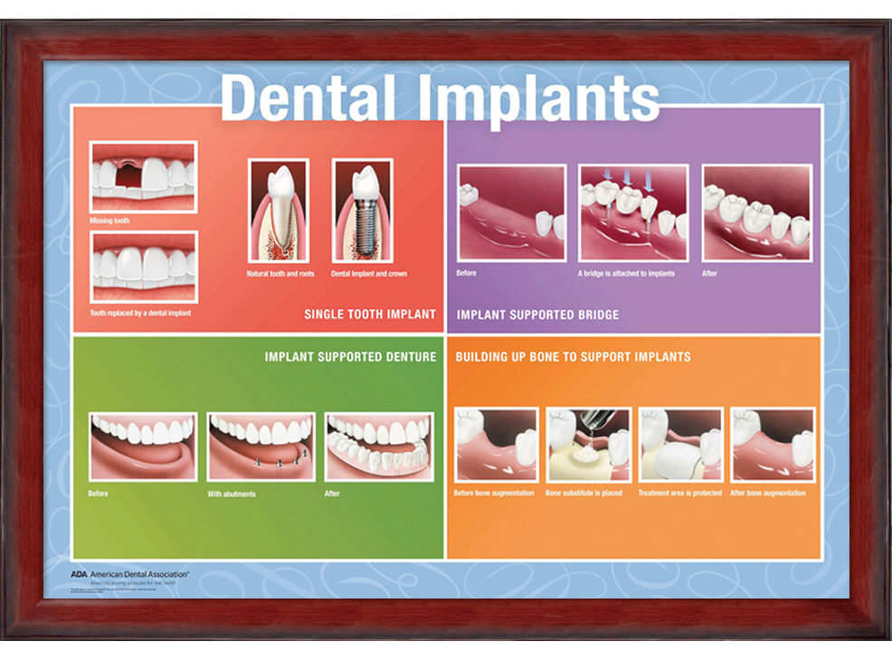 22" x 28" Framed Wall Art, Dental Implants Image 2