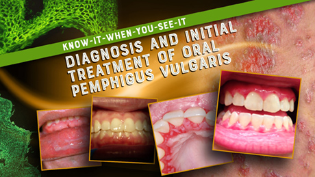 Know-It-When-You-See-It: Diagnosis and Treatment of Oral Pemphigus Vulgaris (Recorded Webinar)