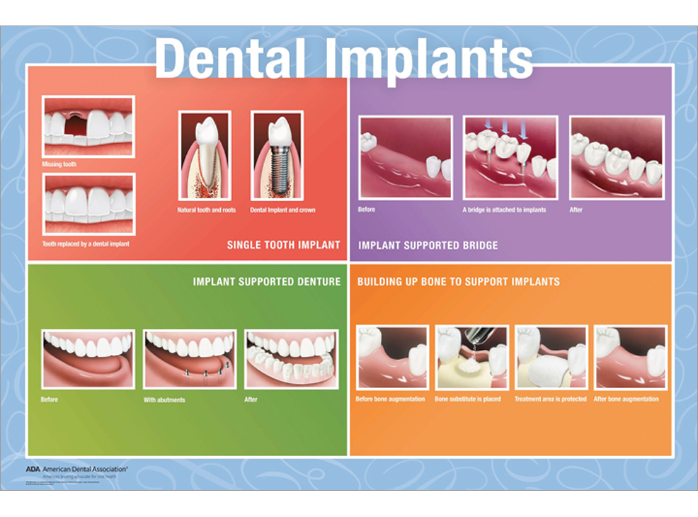 ADA Store - 22x28 Framed Wall Art, Dental Implants